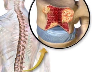 El tratamiento con CARFILZOMIB mejora significativamente la supervivencia de pacientes con mieloma múltiple recurrente
