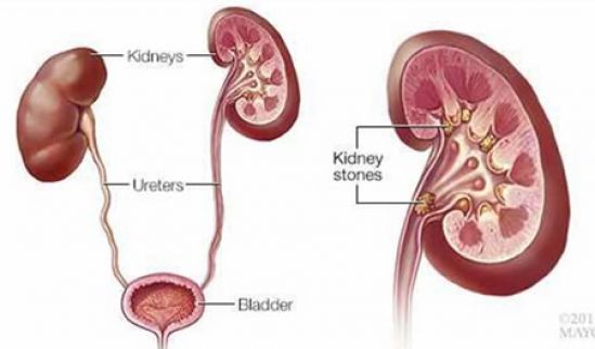 Aumentan los cálculos renales, descubre estudio de Mayo Clinic