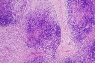 Inmunoterapia nivolumab es aprobada en México para tratar el cáncer escamoso de cabeza y cuello y el linfoma de Hodgkin clásico