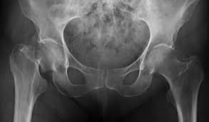 Dale la batalla a la osteoporosis
