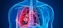Cáncer de pulmón, primera causa de muerte por cáncer en hombres y mujeres