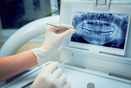 Creación de mandíbulas virtuales clave en el éxito de los implantes dentales