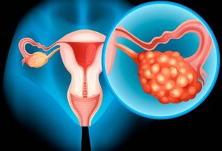 El cáncer de ovario es el cáncer ginecológico más letal