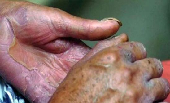 México comprometido para elimeinar la lepra