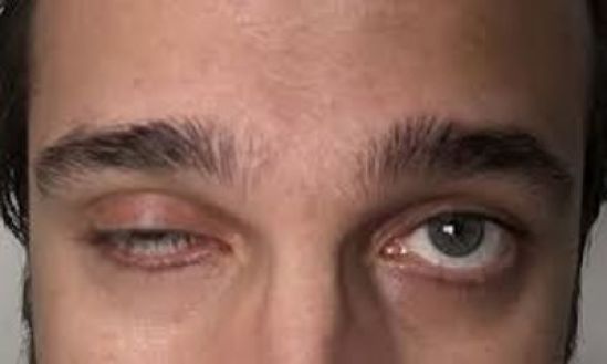 Miastenia Gravis, enfermedad que te debilita