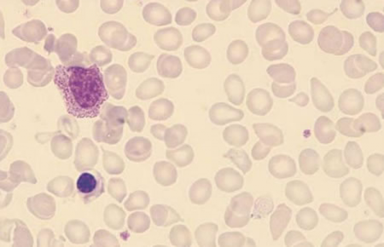 Avances en el tratamiento de la mielofibrosis, un cáncer hematológico potencialmente mortal