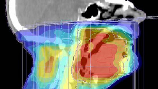 En México, 70% de algunos tipos de cáncer de cabeza y cuello se detectan en etapas avanzadas