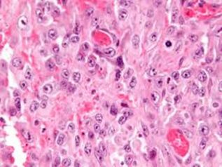 Investigadores de Mayo Clinic precisan causa y posible tratamiento para tipo raro de sarcoma