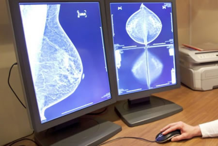 Presentan nuevos datos sobre medicamentos para cáncer de mama en el Simposio de Cáncer de Mama de San Antonio Texas 2019