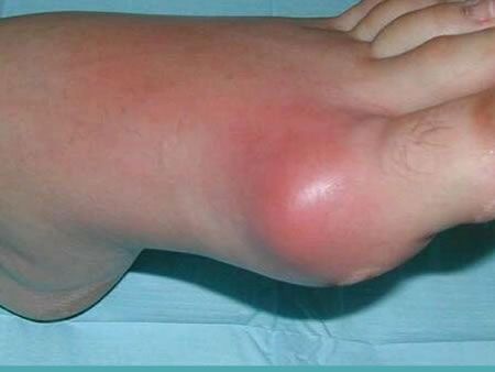 Gota, enfermedad que afecta a 3% de los mexicanos 