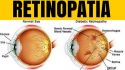 La retinopatía diabética no presenta síntomas