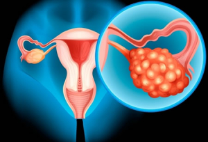 En México, el cáncer de ovario tiene una mortalidad del 60%
