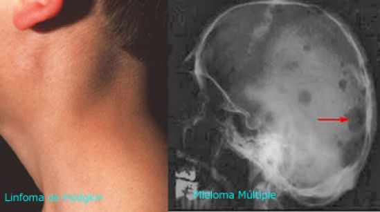 Diagnóstico oportuno principal reto para médicos y pacientes con Mieloma Múltiple y Linfoma de Hodgkin