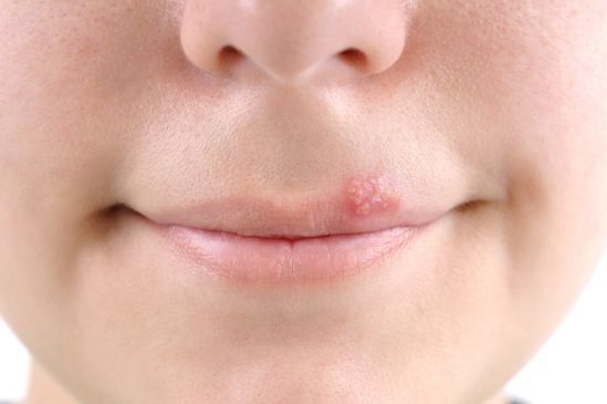 Consejo de salud: herpes labial. Como cuidarlo
