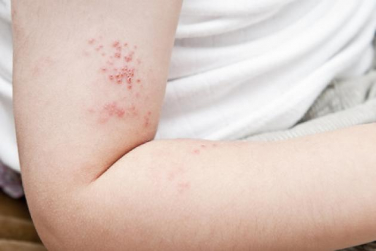 Uno de cada 3 adolescentes con dermatitis atópica no alcanzan el control de su enfermedad