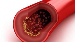 Confinamiento puede llegar a provocar riesgo cardiovascular en mexicanos por colesterol alto