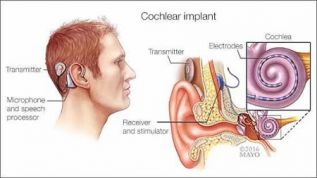 Exitoso trasplante facial de Mayo Clinic
